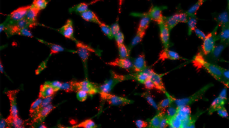 Prostate cancer cells interacting with polymeric nanoparticles coated with targeting molecules.