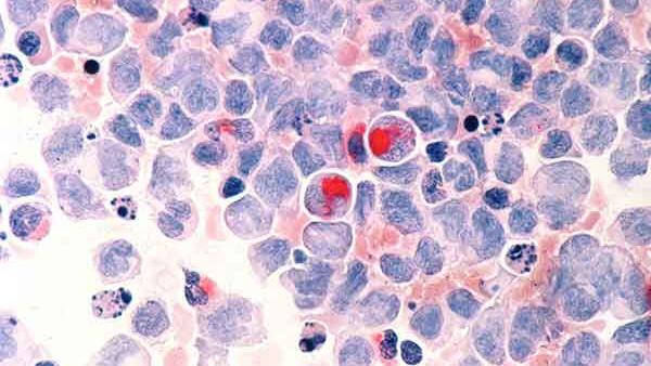 Human cells with acute myelocytic leukemia as seen through a microscope