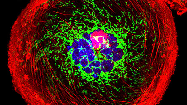 A polyploid giant cancer cell from triple-negative breast cancer in which actin is red, mitochondria are green, and nuclear DNA is blue.