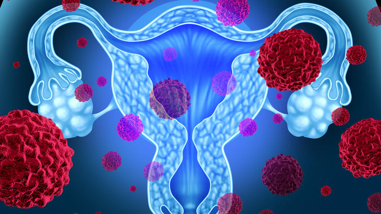 Drawing of targeted therapy surrounding the female reproductive system, including the uterus and endometrium.