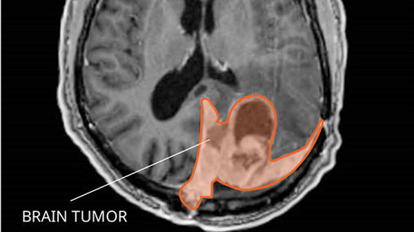 A meningioma in brain tissue seen in a slice from a magnetic resonance imaging (MRI) procedure.