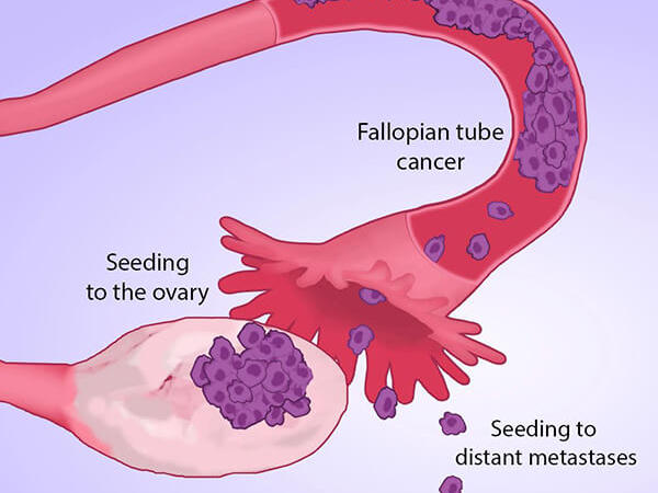 Many Ovarian Cancers May Start In Fallopian Tubes Nci 
