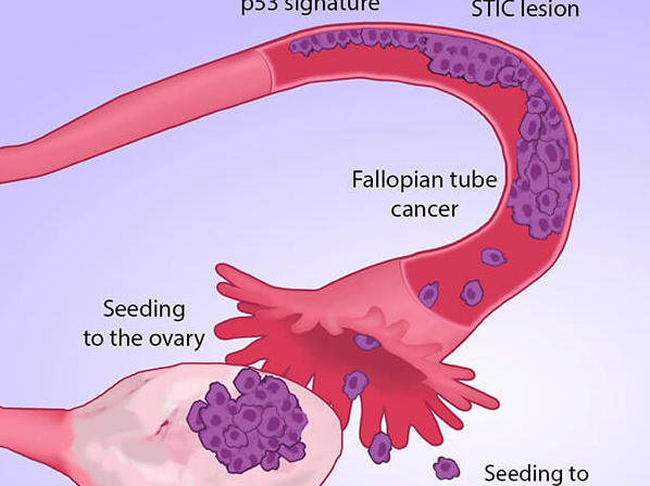 Many Ovarian Cancers May Start In Fallopian Tubes Nci 