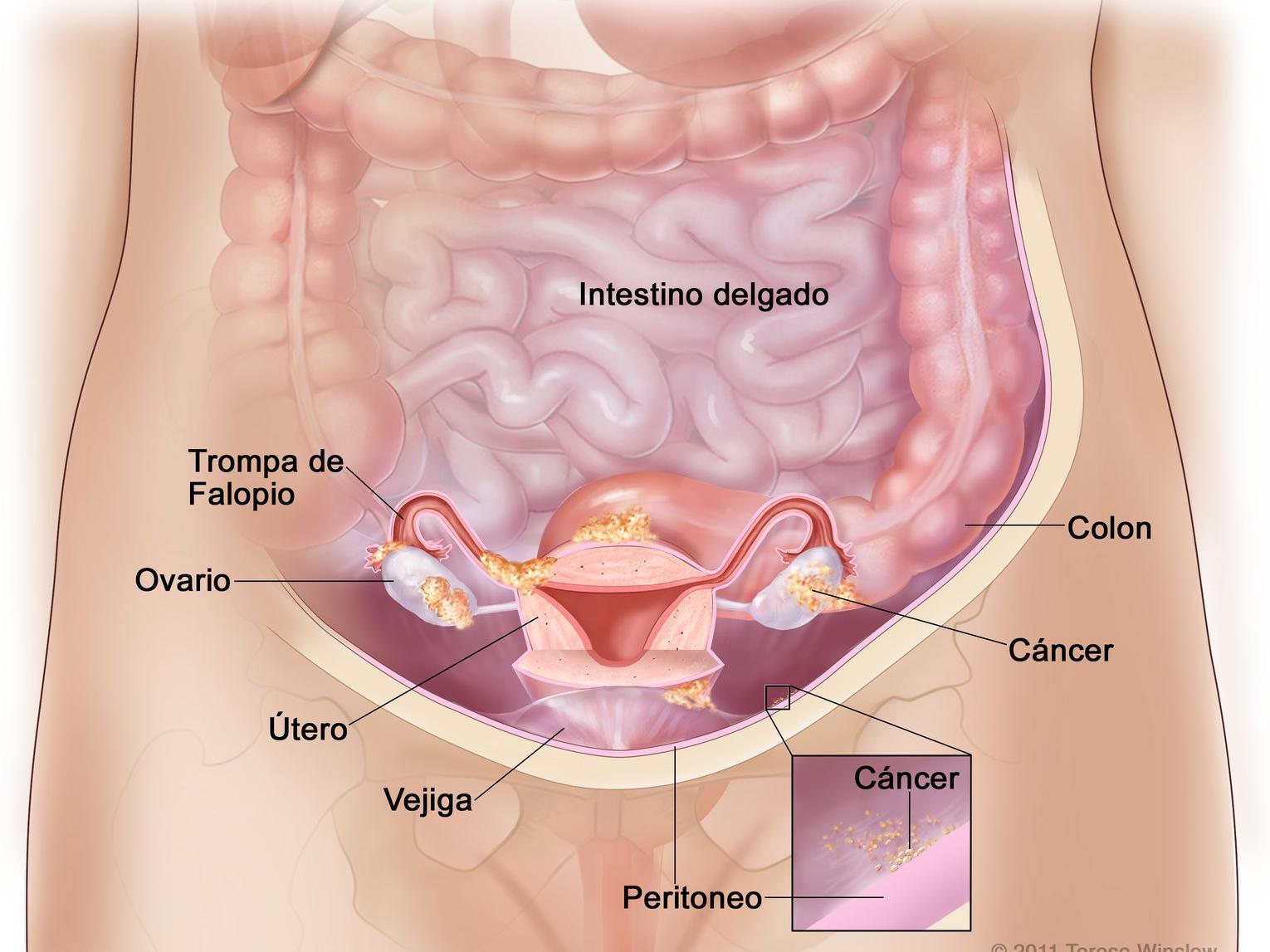 Cancer colon y ovario. TUMOR GIGANTE DE OVARIO papilloma of tongue