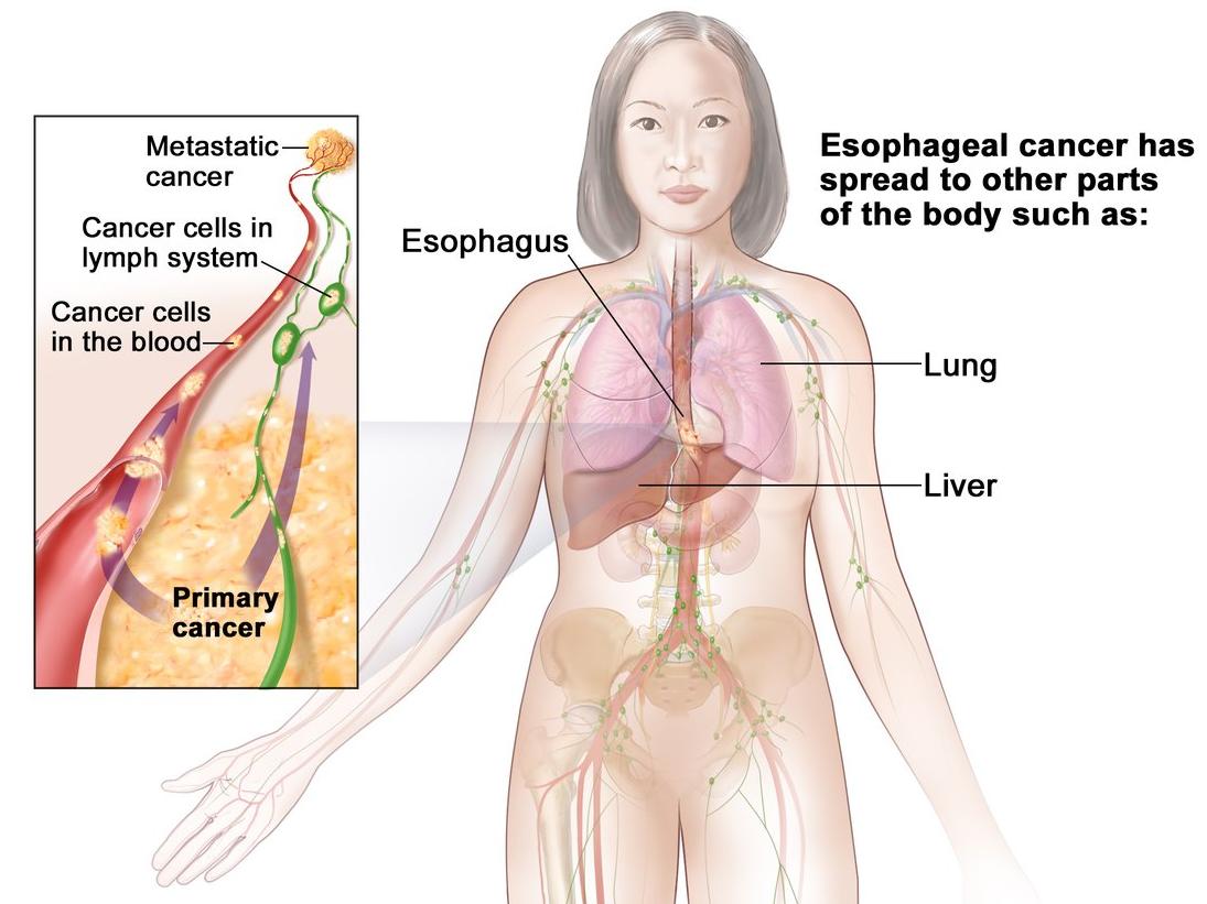 Metastatic cancer esophageal