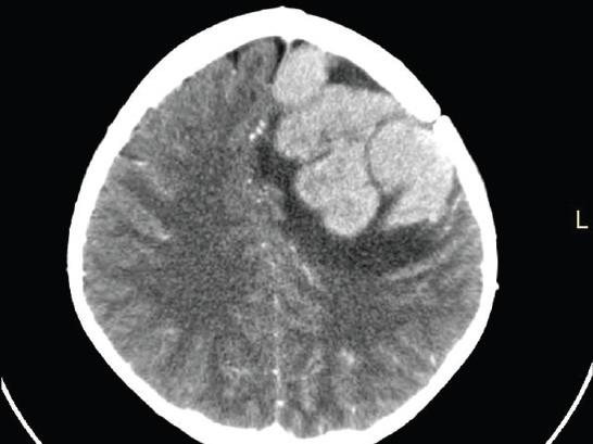 Children With All Can Skip Brain Radiation National Cancer Institute