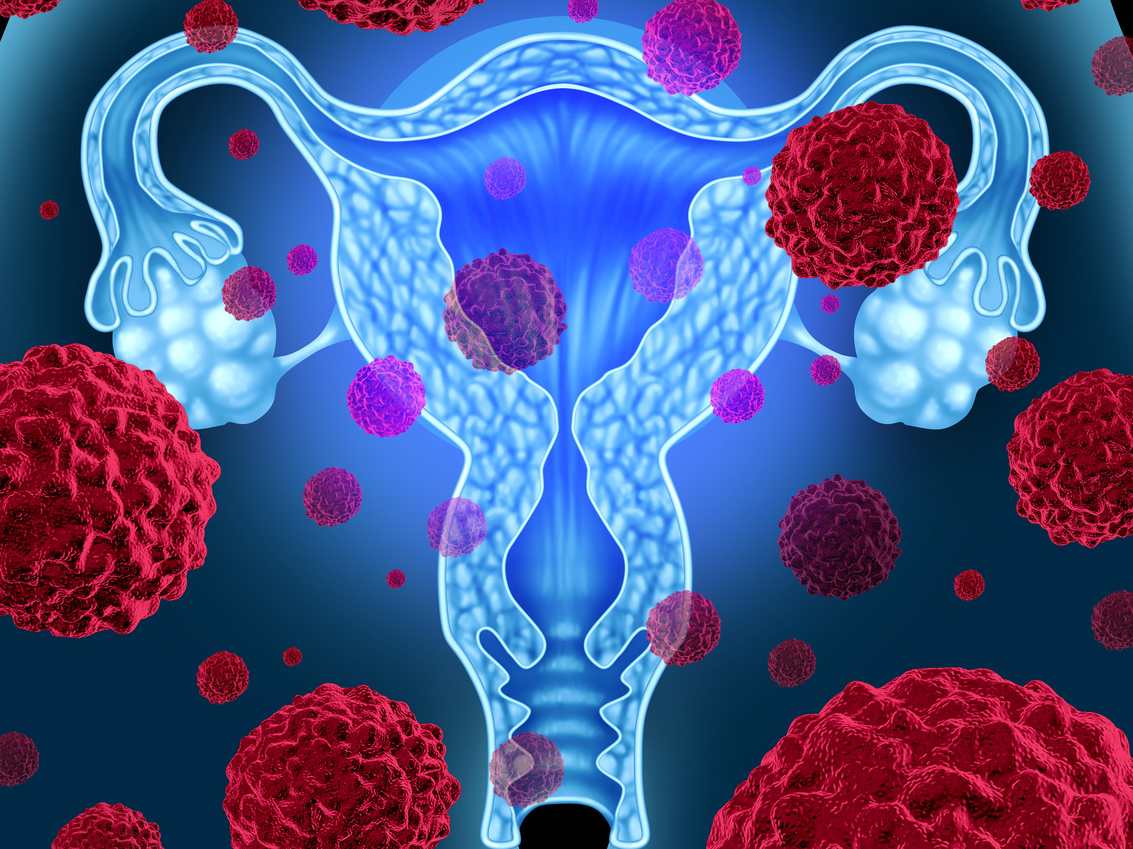 Рак яичников терапия. Раковые заболевания яичников. Гинекологические опухоли. Опухоли женской репродуктивной системы. Гинекологические заболевания картинки.