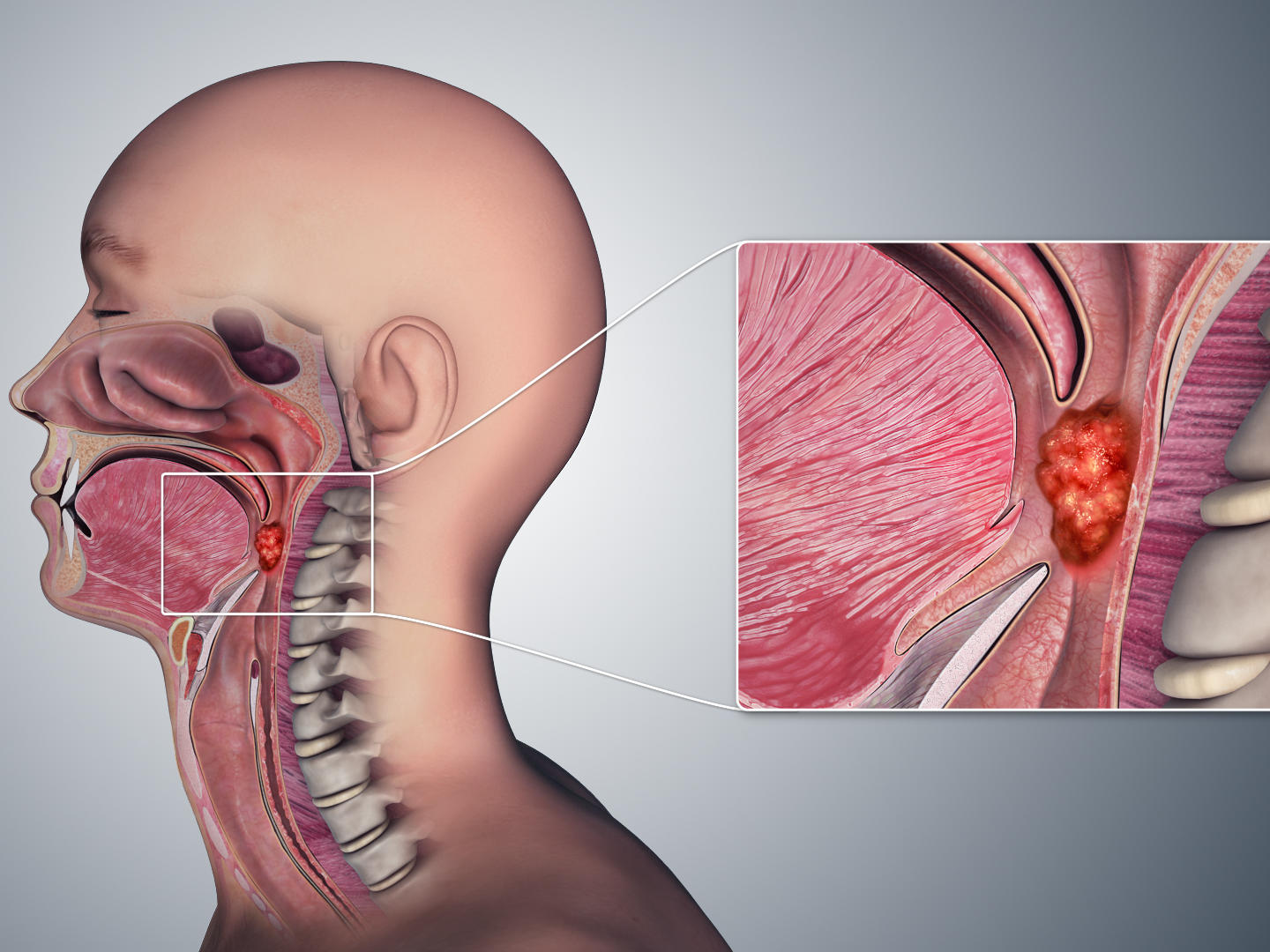 hpv throat cancer prognosis