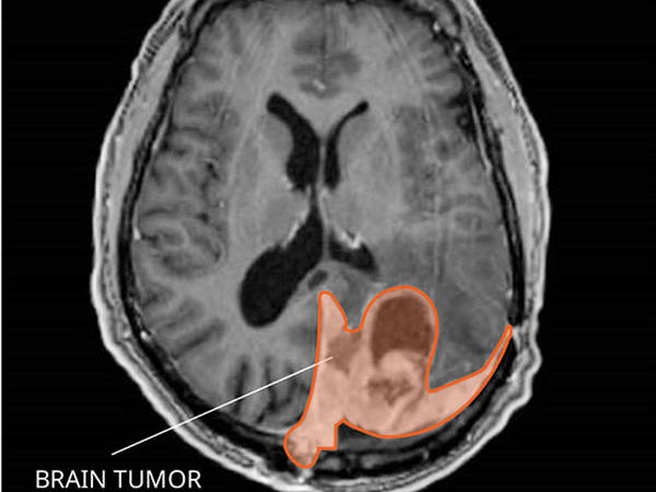 Brain Cancer Concept Anatomical Shape Of Brain Lies Near Word Cancer  Surrounded By Set Of Tests Analysis Drugs Mri Of Skull And Stethoscope  Diagnosis Treatment Of Brain Cancerous Tumors Stock Photo 