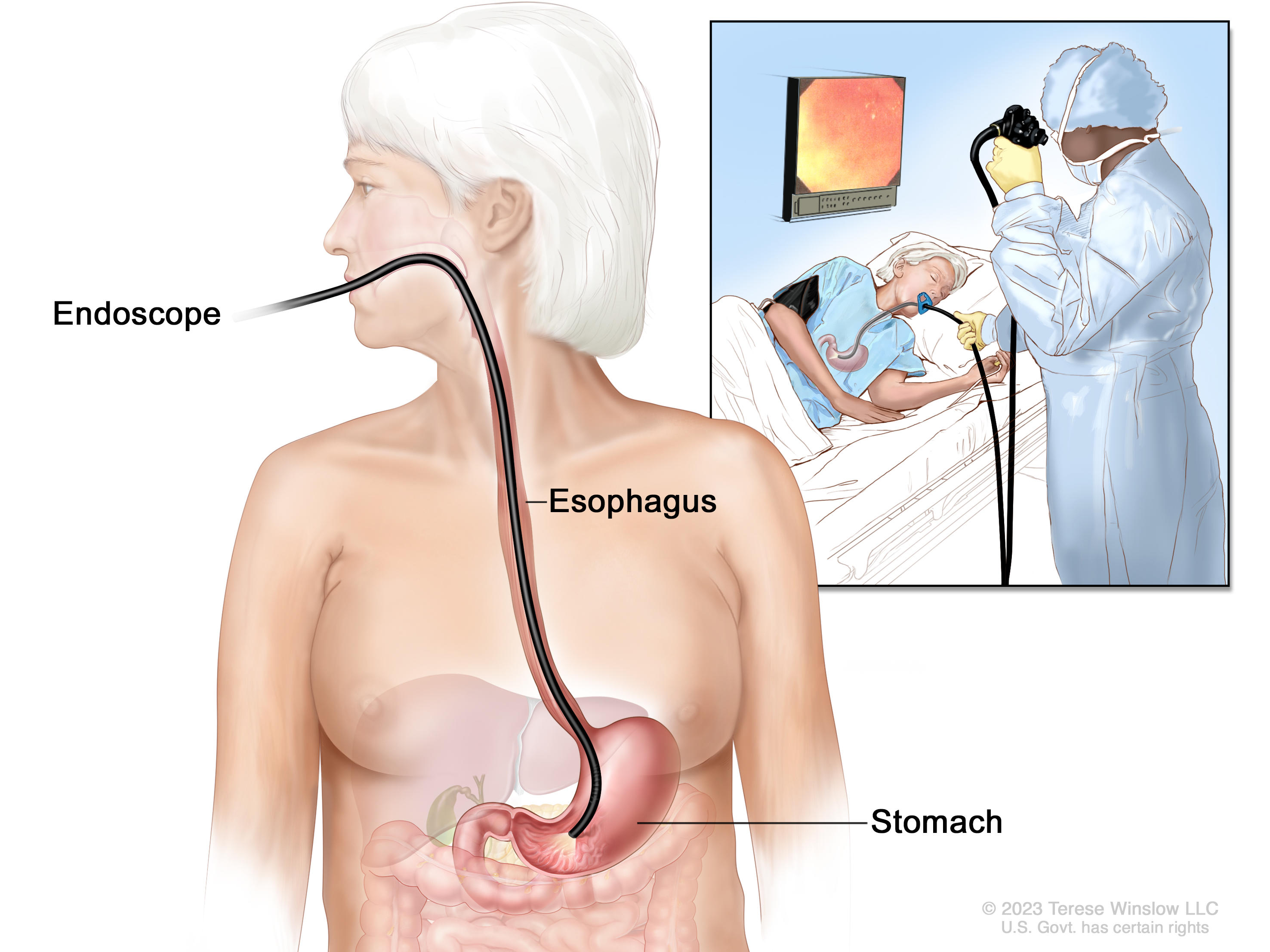 Advanced Endoscopy For Cancer Detection - wk5hchw