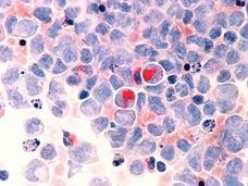 Human cells with acute myelocytic leukemia as seen through a microscope