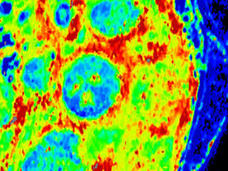 Follicular lymphoma cells stained purple (left) and a scanning acoustic microscopy image of follicular lymphoma cells in neon green, red, and blue (right)