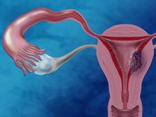 Illustration of the female reproductive system showing cancer cells in the endometrium.