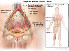 An illustration of blood cancer that has spread to other parts of the body.