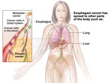 An anatomic illustration of stage IVB esophageal cancer.