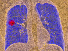 Stock illustration of a cancerous tumor in a human lung