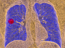 A CT scan of a person with lung cancer.