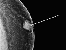 Image of a diagnostic mammogram showing a breast mass in a male patient.