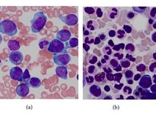 Pathology slides from a patient with acute myeloid leukemia that has relapsed (left) and after remission (right).
