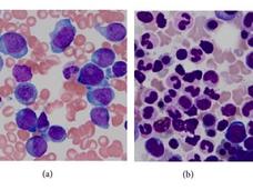 Preparaciones histopatológicas de un paciente con leucemia mieloide aguda recidivante con una mutación de FLT3 (izquierda) y después de remisión (derecha).