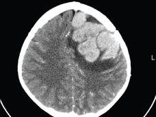 A CT scan of a tumor recurrence in the brain of a child with ALL.