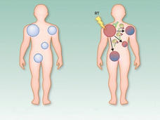 An illustration of the abscopal effect, which occurs when treating a single tumor with radiation alone or with other treatments causes other tumors in the body to shrink.
