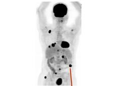 PET/CT scan of a patient with metastatic melanoma.