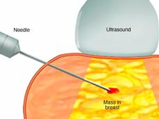 Illustration of a core needle biopsy of the breast.