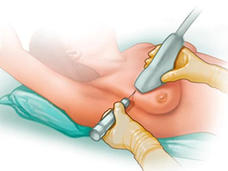 Ilustración de una biopsia con aguja gruesa.