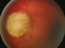 Retinoblastoma of the eye