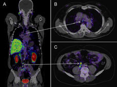 PSMA PET-CT images of a man with prostate cancer show metastases in lymph nodes in the chest and abdomen.