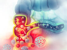 Ilustración de células cancerosas en el colon