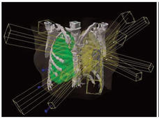 A case of stereotactic body radiation therapy (SBRT) for early stage lung cancer (T1N0M0)