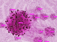 Composite image of endometrial cancer