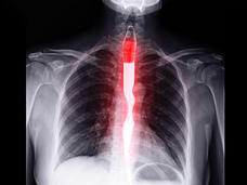 An x-ray of the esophagus shown with barium contrast.