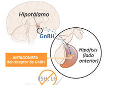 Imagen del efecto del relugolix en el cáncer de próstata avanzado