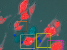 View from a microscope showing T cells killing uveal melanoma cells after treatment with tebentafusp.