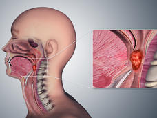 Anatomical illustration of a tumor in the oropharynx of a male.