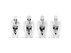 PSMA-based PET scans of a man with prostate cancer at the beginning of treatment with 177Lu-PSMA-617 and after 6 cycles of the therapy.