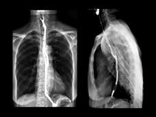 X-ray highlighting the esophagus following a barium swallowing procedure.