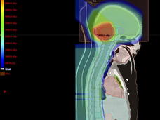 a CT scan of of the radiation therapy plan for child with medulloblastoma