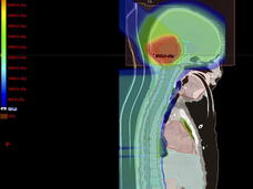 CT image of radiation plan for child with medulloblastoma