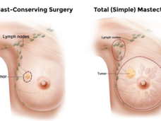 Side by side illustrations of breast-conserving surgery and a simple mastectomy.