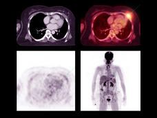 Multiple PET-CT scan images identifying a tumor recurrence in a person with lung cancer.