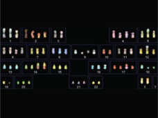 A process called spectral karyotyping shows widespread aneuploidy in a cell line of lung cancer.