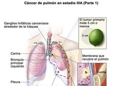 En la imagen se observan un tumor primario que mide 5 cm o menos en el pulmón izquierdo y ganglios linfáticos cancerosos alrededor de la tráquea. También se observa que el cáncer se diseminó al bronquio principal izquierdo y a la membrana que recubre el pulmón.