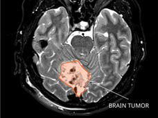 MRI of a medulloblastoma in the brain.