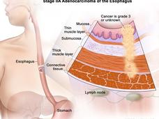 Esophageal Adenocarcinoma Stage IIA