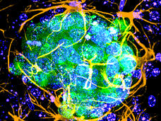 Melanoma cells in the brain being enveloped by astrocytes, which are branch-like structures.