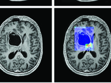 Image of cranial scan showing IDH1 mutant glioblastoma